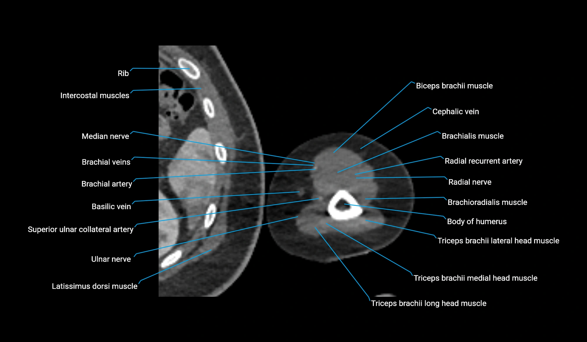 CT upper arm axial  cross sectional anatomy labelled radiology image -00330.webp